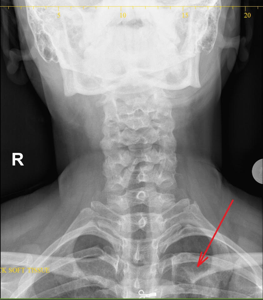 Dysphagia: Can Be A Deceptive Presentation